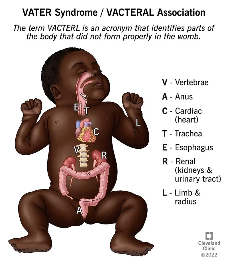 What's the Deal with VACTERL Association?